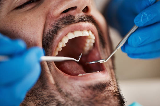 Best Emergency Dentist for Lost Fillings or Crowns in Morgandale, OH